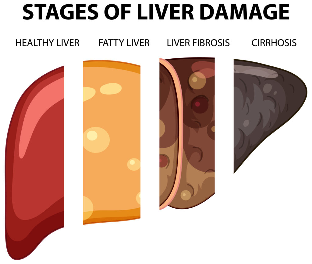4 Stages of Liver Cancer, Liver Cancer Symptoms, treatment and diagnosis