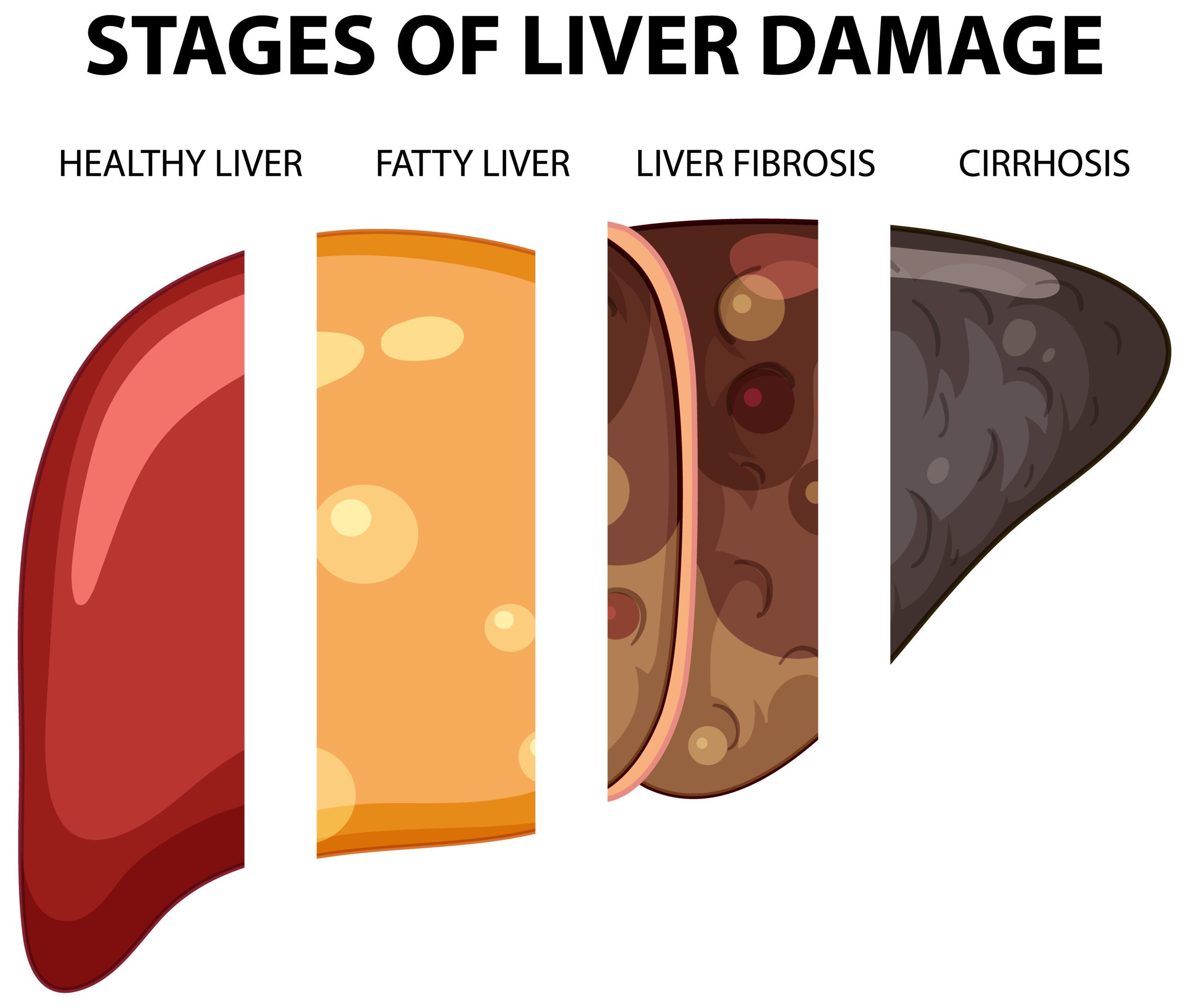 Understanding 4 Stages of Liver Cancer: Warning Signs and Symptoms