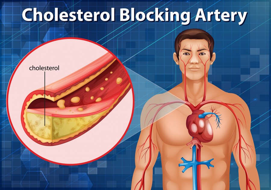 Cholesterol