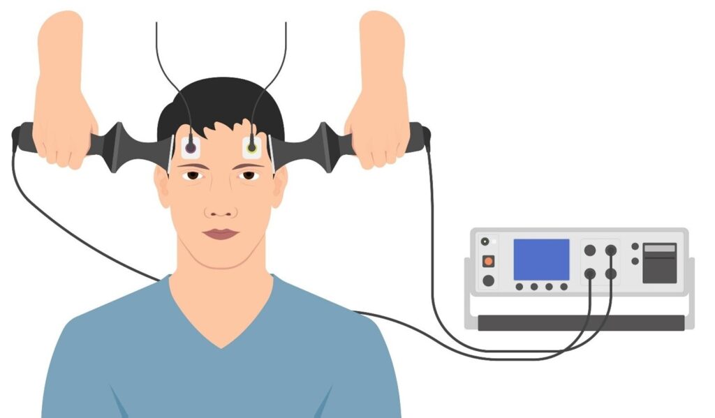 Electroconvulsive Therapy
