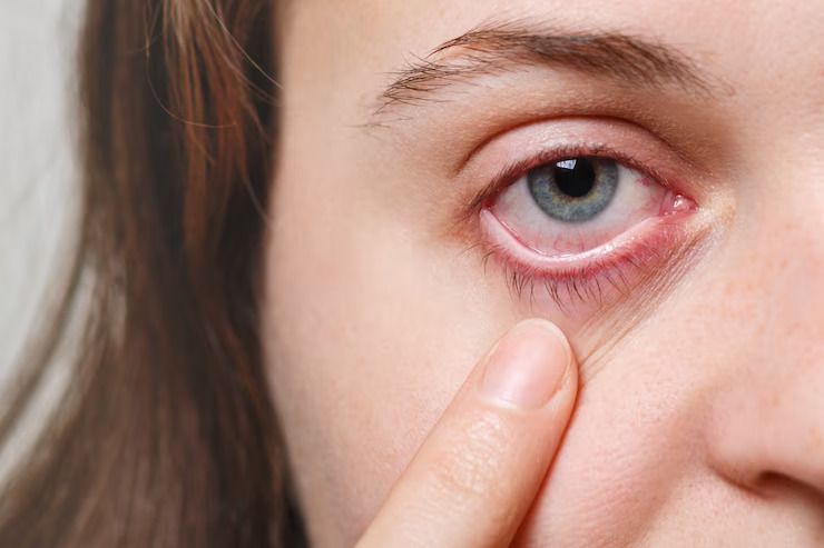 Eye Flu Medicine image