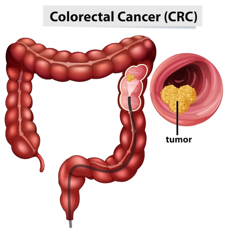 Gallbladder Cancer: Early Detection and Effective Treatment Strategies