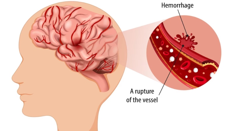 Hemorrhagic Stroke Paralysis: Causes, Symptoms, Treatment