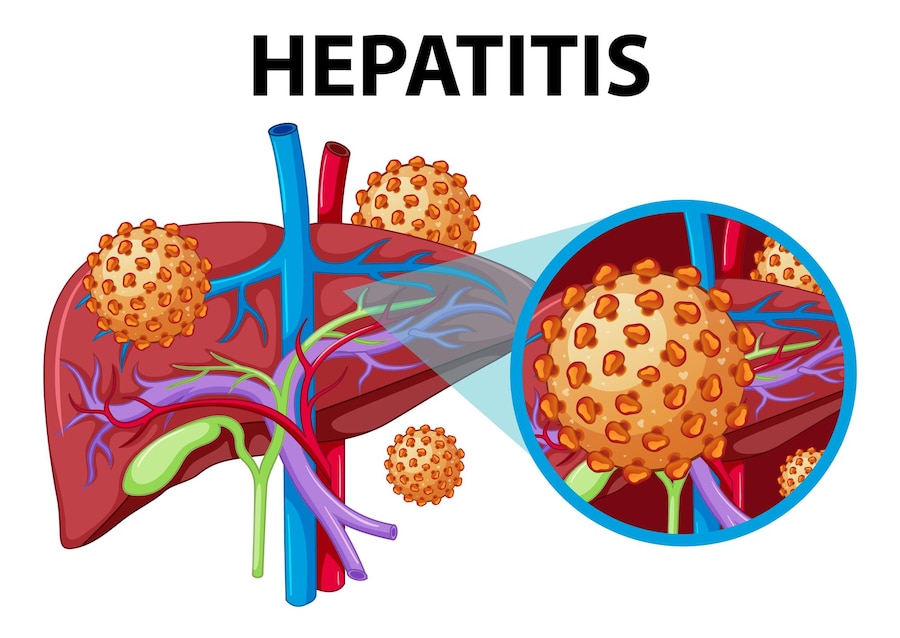 Hepatitis A & Hepatitis B: Diagnosis & treatment | Inflammation of liver