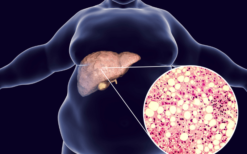 Understanding Grade 1, 2 and 3 Fatty Liver: Symptoms and Prevention Techniques