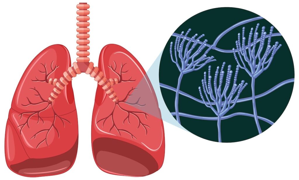 Latent Tuberculosis