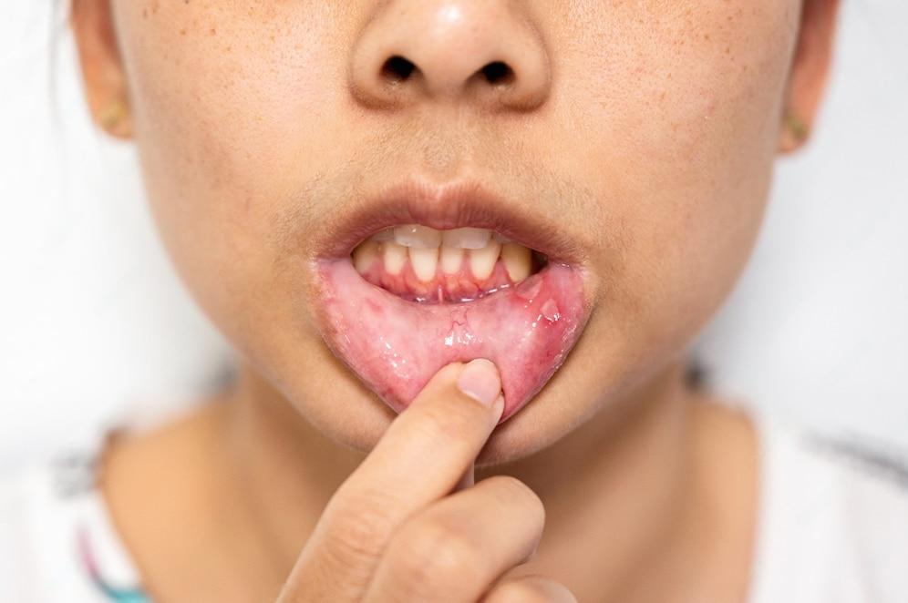 How to Cure Mouth Ulcers? Best Ointment for Mouth Ulcer