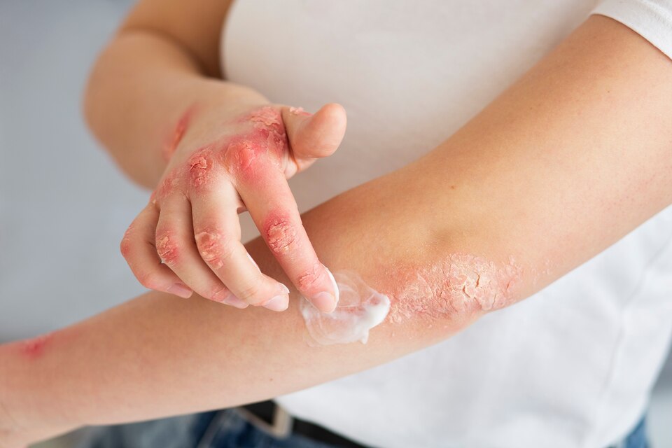 Understanding and Treating Roseola in the Early Stages | Symptoms and Causes