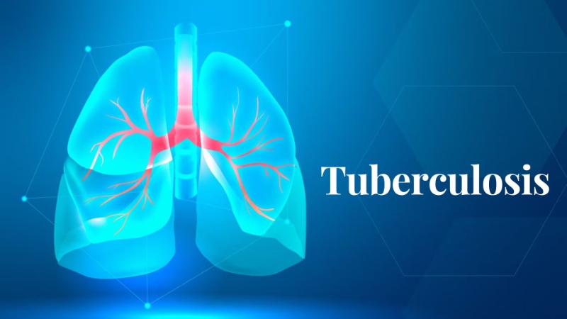 All about Tuberculosis: Types, Prevention & drugs for treatment