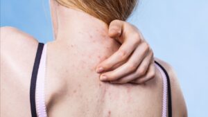 Acne Treatment