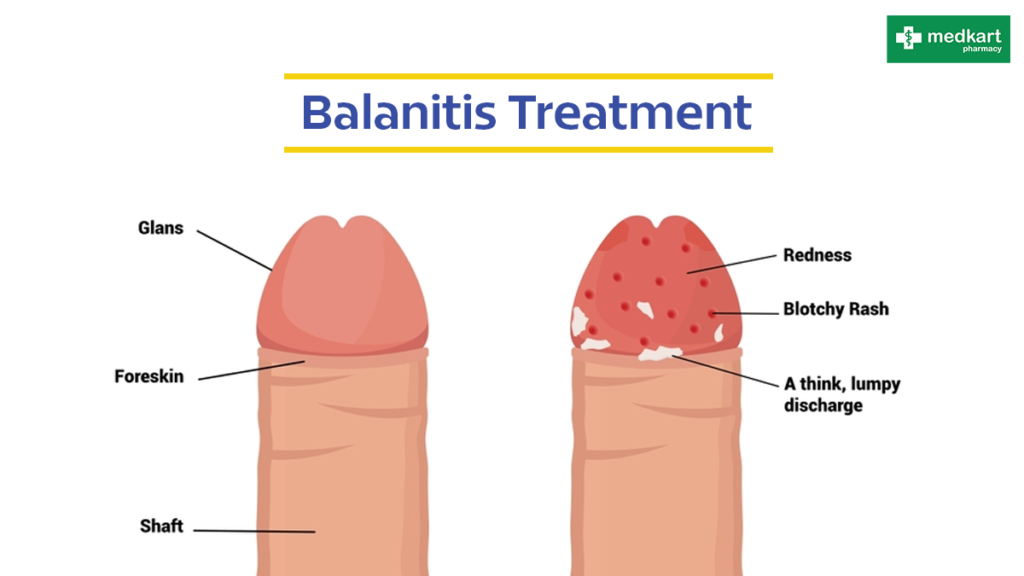 Balanitis Treatment image