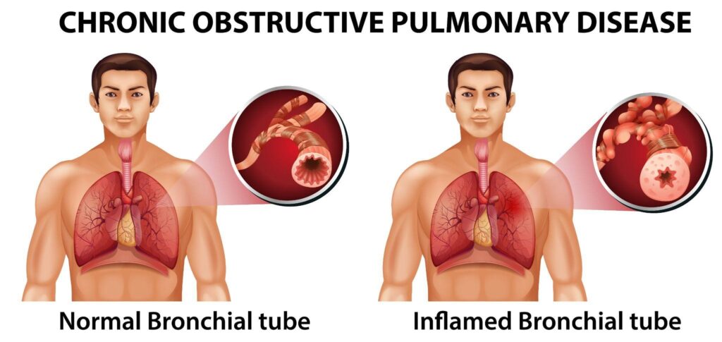 chronic obstructive pulmonary disease image