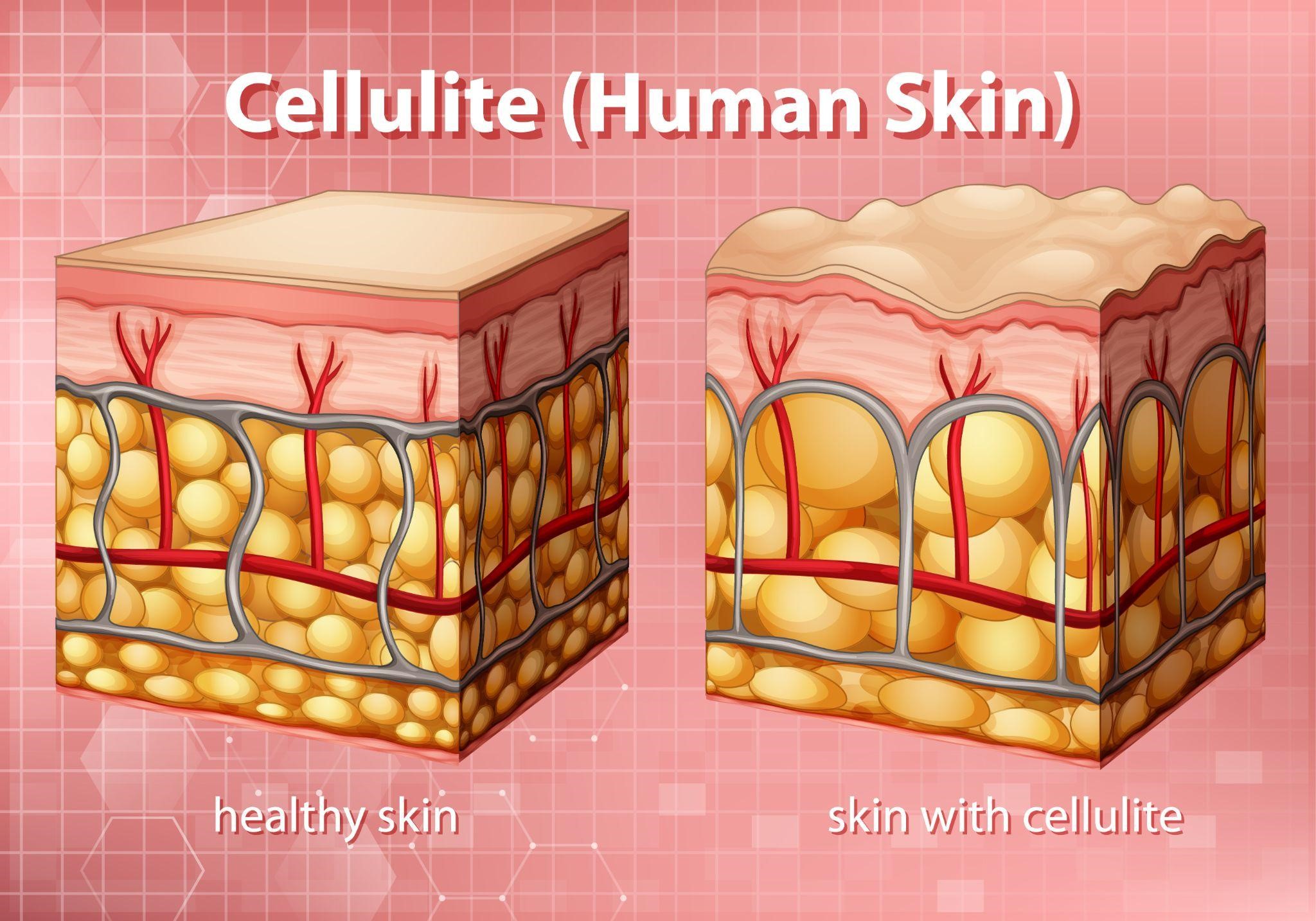 Cellulitis Treatment