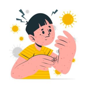 चिकन पॉक्स ट्रीटमेंट