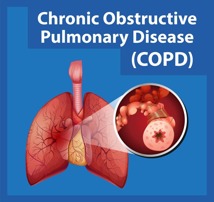 Chronic Obstructive Pulmonary Disease Treatment – COPD Treatment