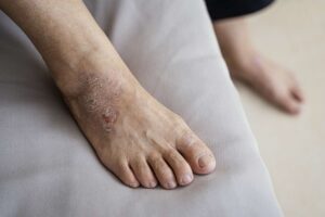 Eczema Treatment
