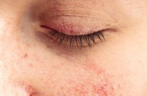 Eczema Treatment