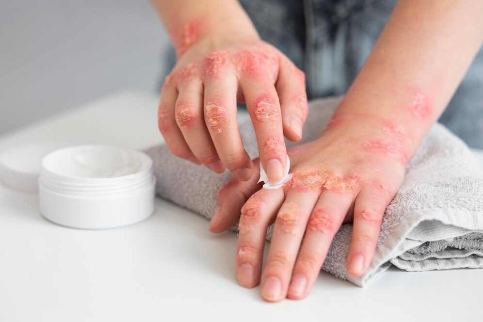 Fungal Infection Treatment: Home Remedies for Fungal Infections