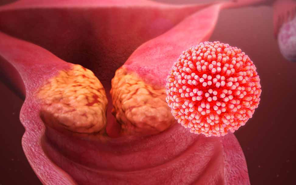 Genital Herpes