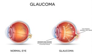 Glaucoma Treatment in Hindi