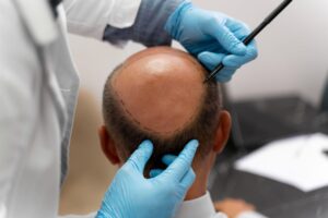 Hair Loss Treatment in Hindi