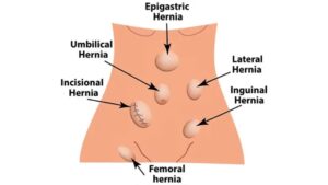 Hernia Treatment in Hindi