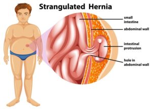 Hernia Treatment in Hindi