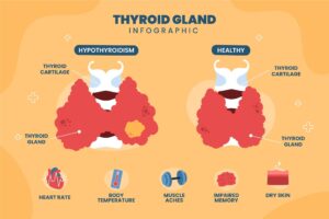 Hypothyroidism Treatment