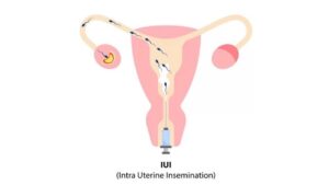 IUI Treatment