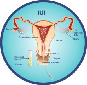 IUI Treatment