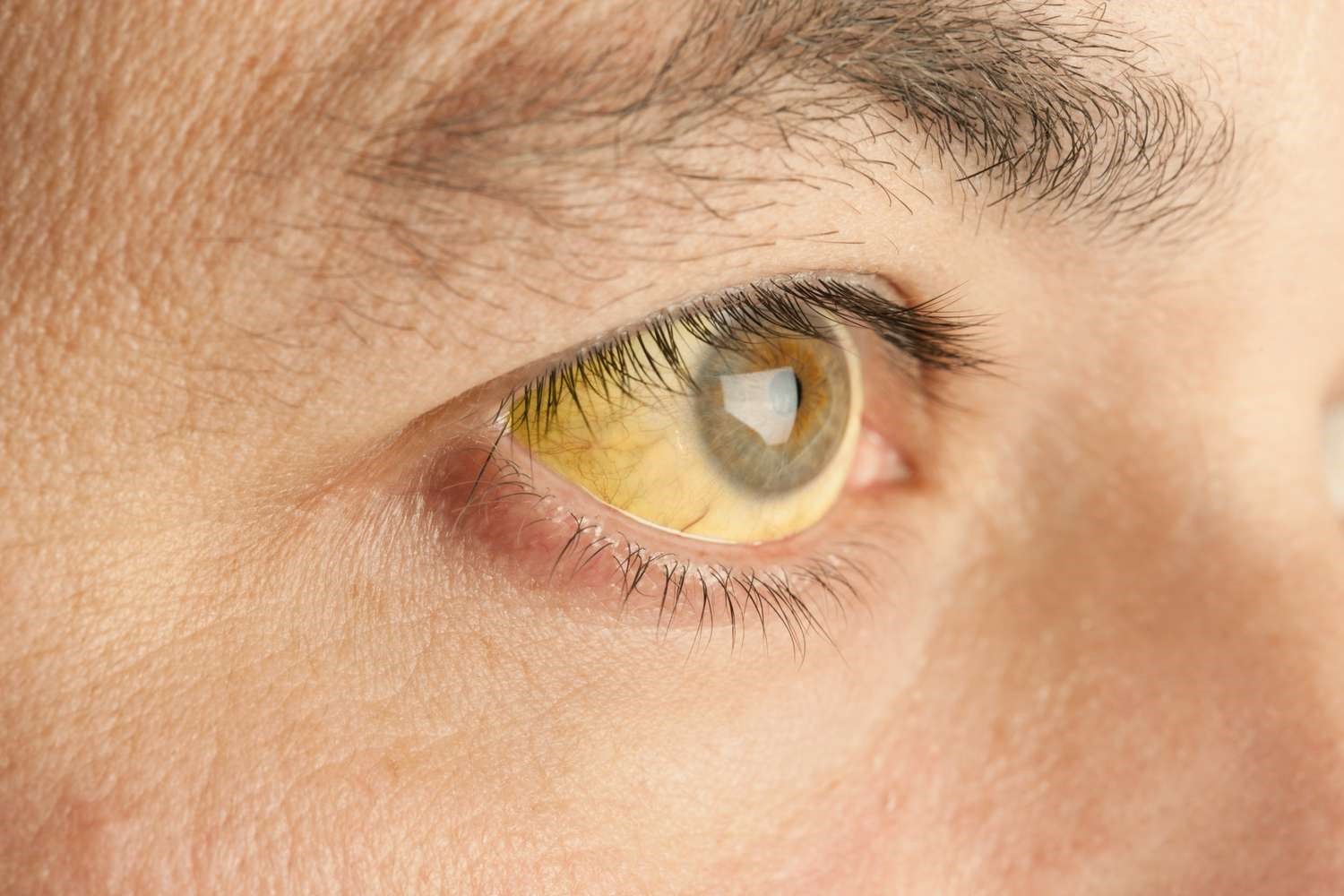 Jaundice Treatment – Home Remedies for Jaundice
