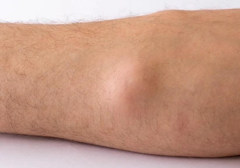 Lipoma Treatment image