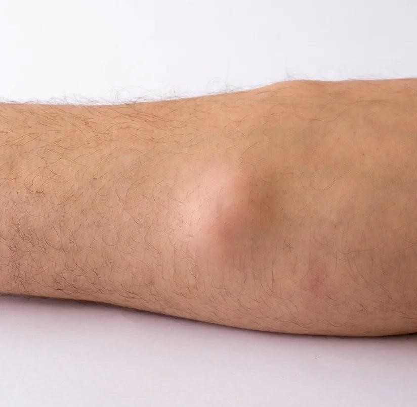Lipoma Treatment image
