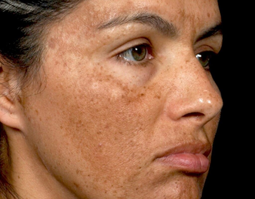 Melasma image