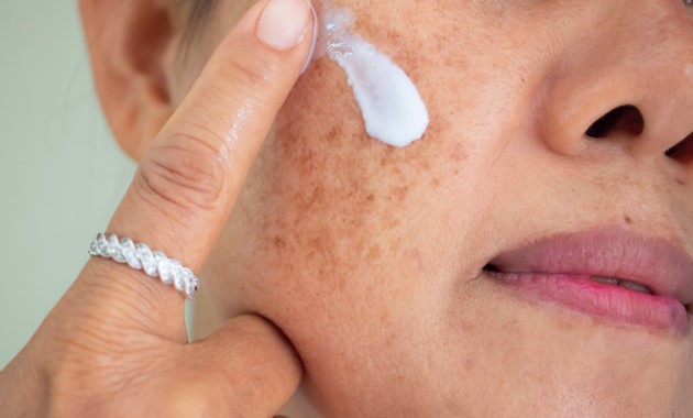 Melasma cream image