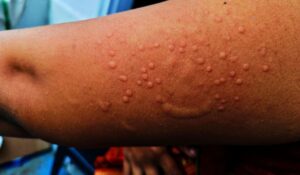 Monkeypox Treatment in Hindi