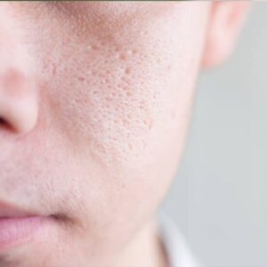 Open Pores Treatment in Hindi