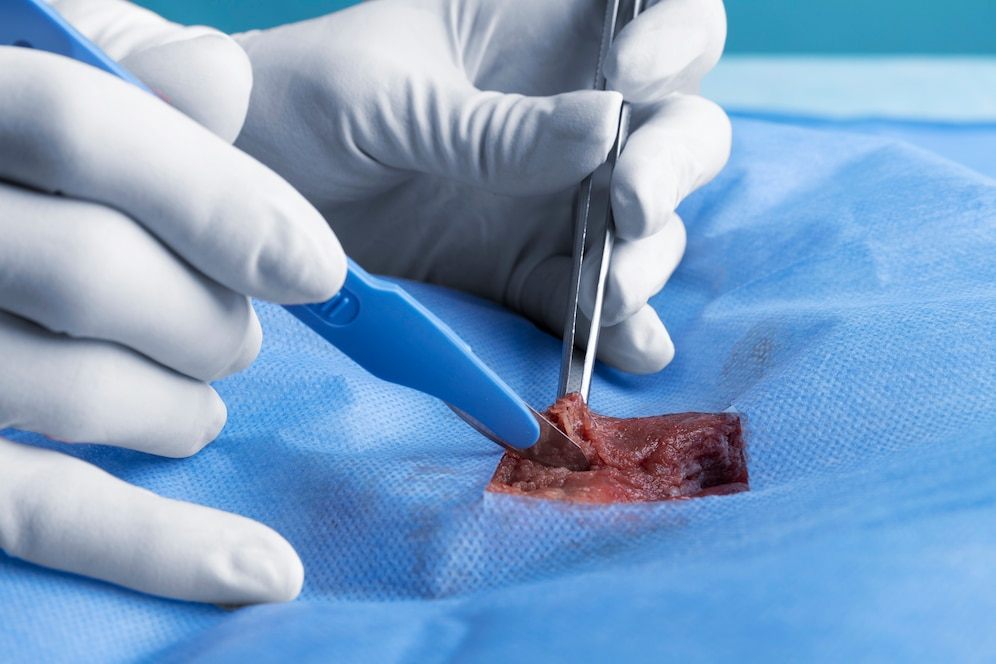 Phimosis Treatment and Diagnosis: Causes, Symptoms of Phimosis