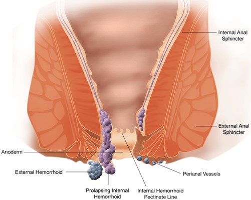 Piles Treatment – Home Remedies and Medication, Laser Treatment for Piles