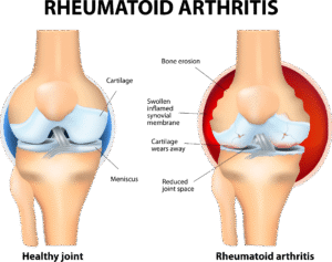 Rheumatoid Arthritis Treatment in Hindi