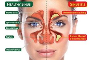 Sinusitis Treatment in Hindi