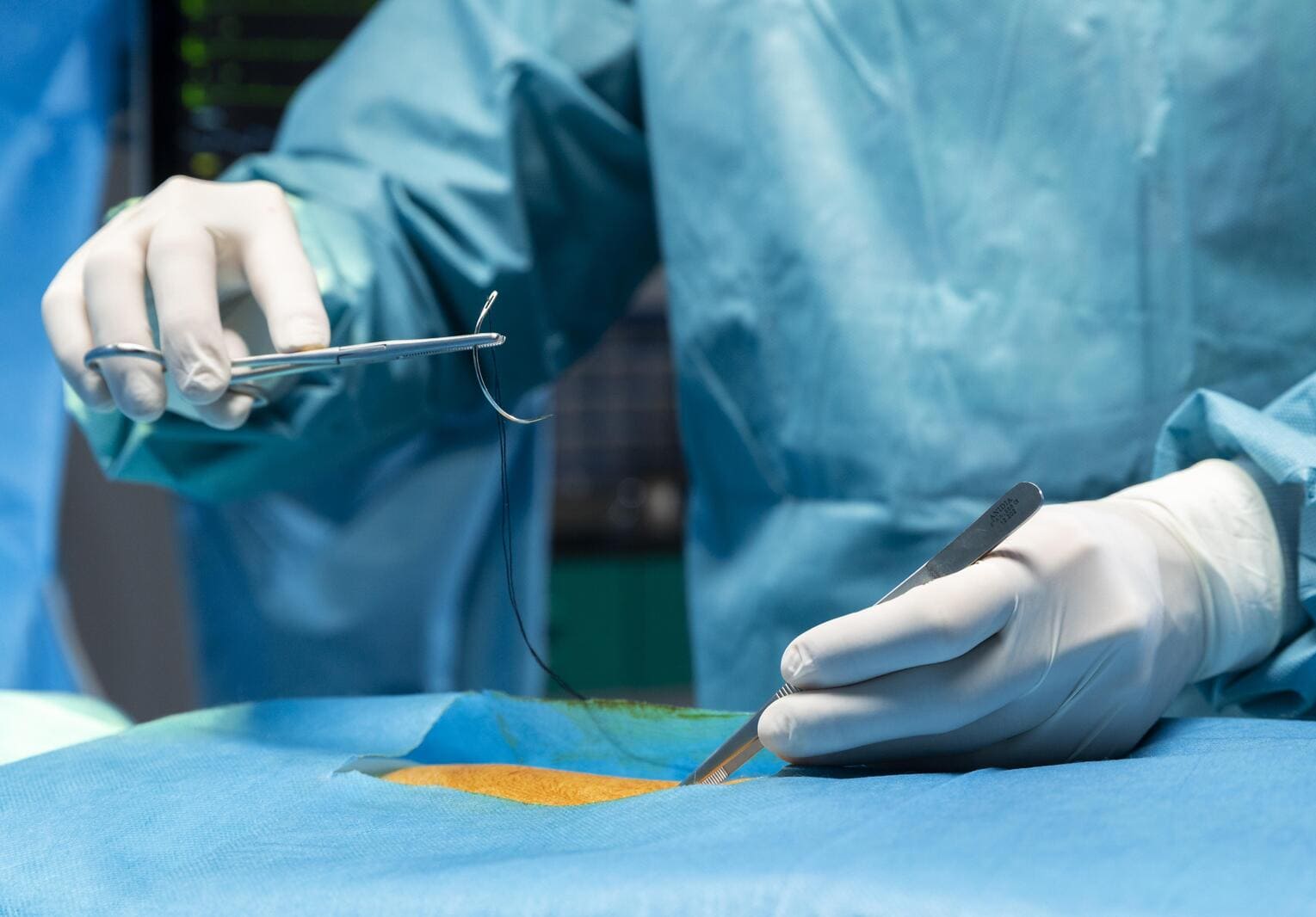 Fistula Treatment: Best Ayurvedic Medicine for Fistula