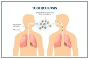Tuberculosis Treatment