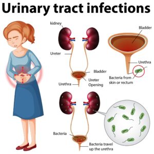 Urinary Tract Infection Treatment