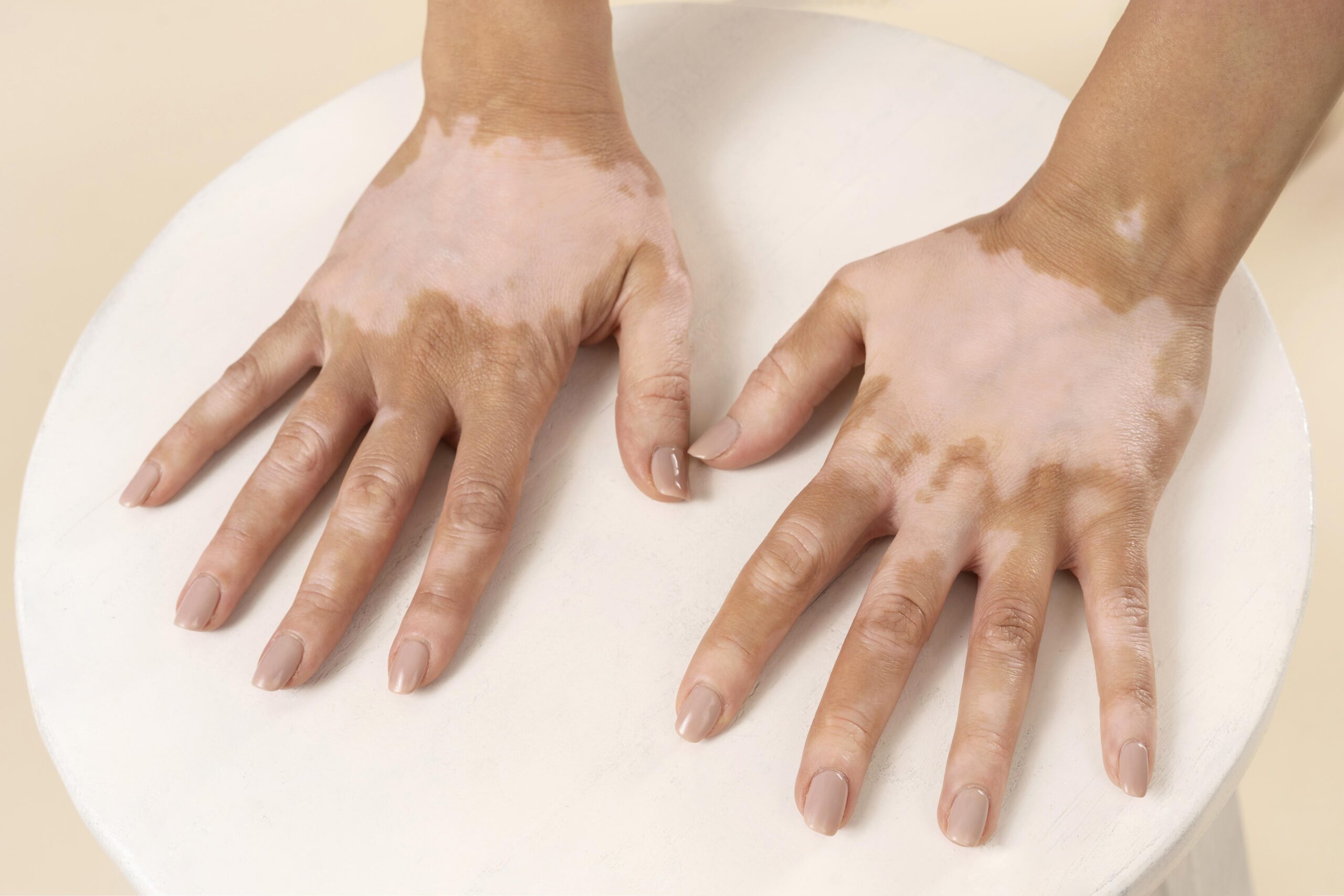 Vitiligo Treatment: Diagnosis, Treatment and Recovery