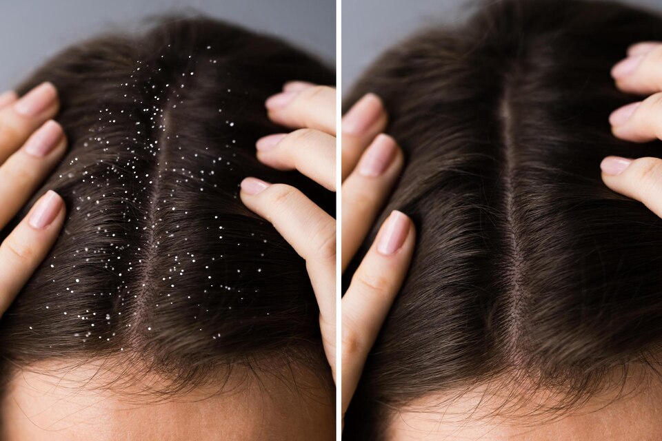 What is the Best Dandruff Treatment?