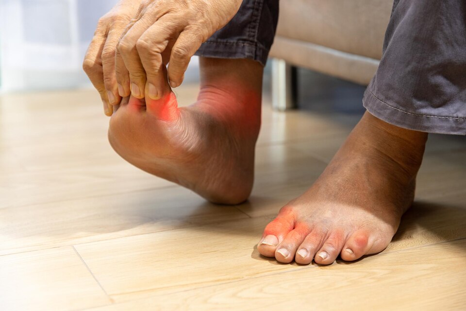 Gout Treatment: Home Remedies, Medication and Diagnosis, Treatment Gout