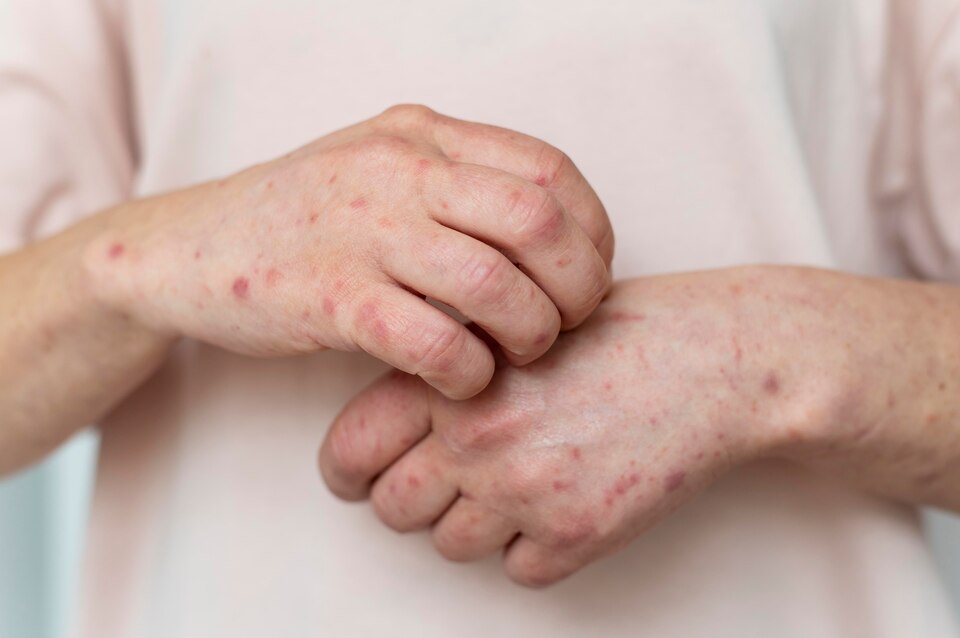 monkey pox treatment