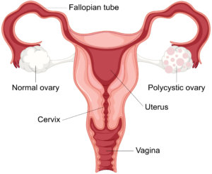 PCOS Treatment