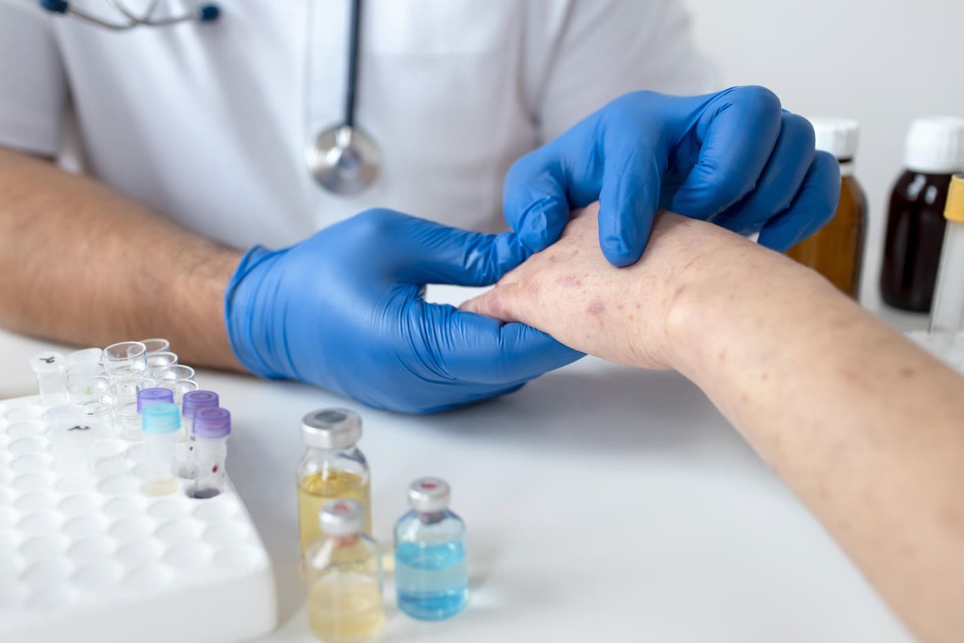 Urticaria Treatment: Best Cream, Hives, Urticaria Ayurvedic Medicine